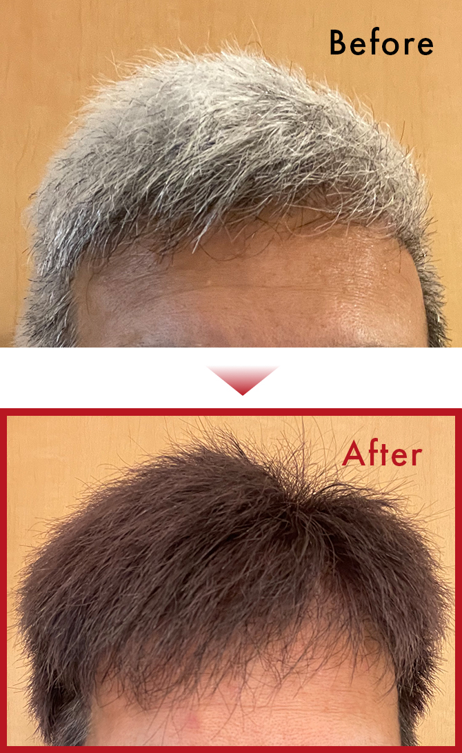 始めて数日はなかなか色着きませんでした。が、続ける事でいい感じに染まりました。のサムネイル