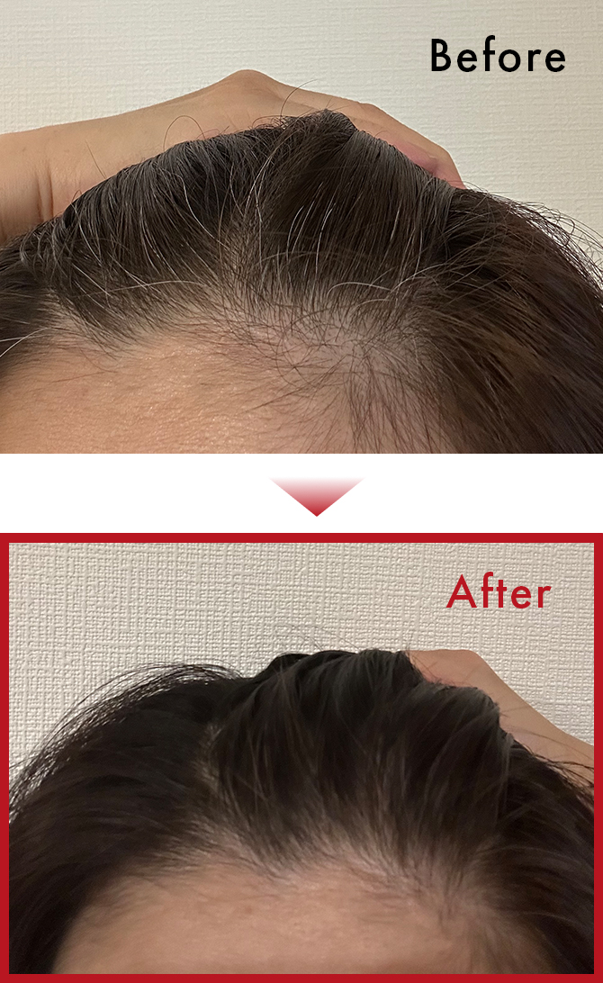 使用後1週間で生え際の白髪が気にならなくなり、嬉しくて姿勢や肌ケアにも気をつけるようになりました。のサムネイル